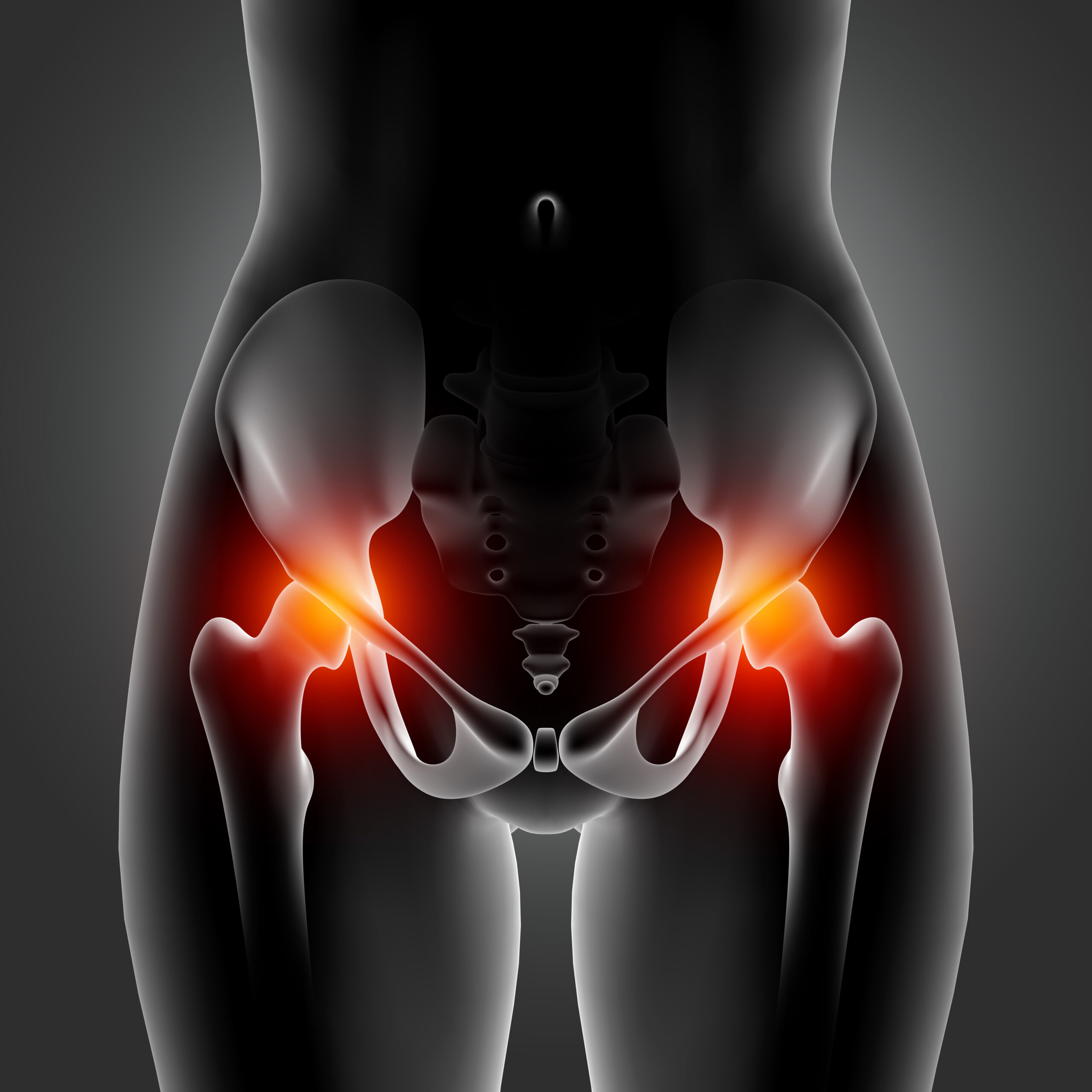Hip Replacement
